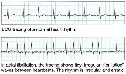 Unduh 570 Gambar Ekg Jantung Koroner  HD