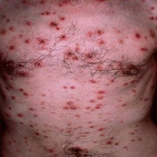 Penyakit Sifilis
