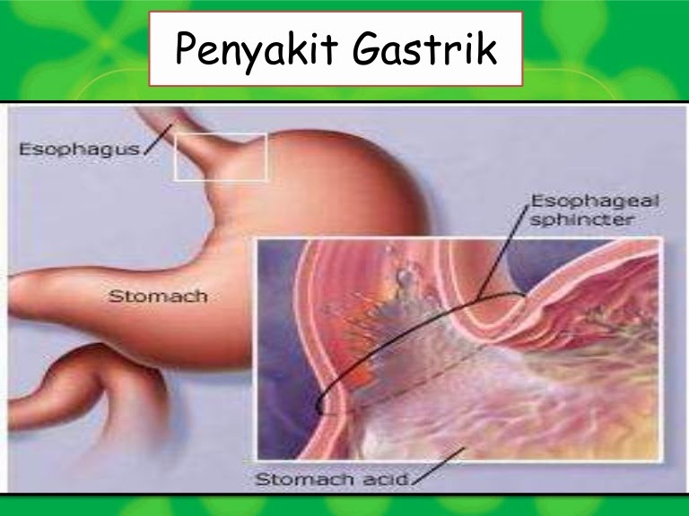 Azizshoppe: Ubat Gastrik paling selamat : Exfuze Seven Plus