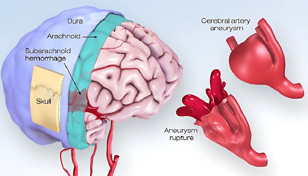 Understanding Brain Aneurysms: Symptoms, Causes, and Treatment Options