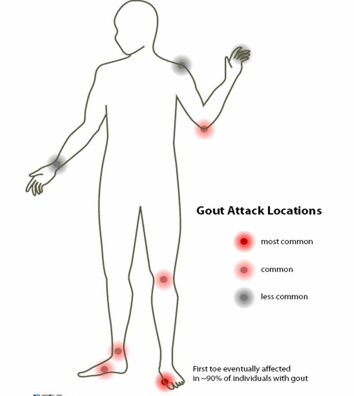 Healthy Life... Beautiful Mind: GOUT- A CHRONIC DISEASE