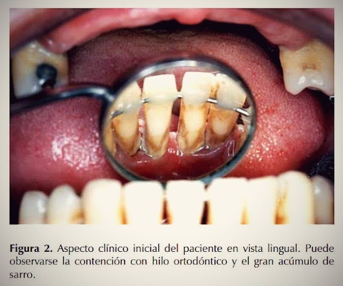 PDF: El uso racional de la ferulización en Periodoncia: Una técnica simplificada y funcional