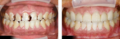 Nhổ răng cửa hàm trên có nguy hiểm không?