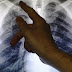 Καρκίνος του πνεύμονα: Διαγνωστικό εργαλείο του ΑΠΘ θα τον ανιχνεύει σε πρώιμο στάδιο - Το πρότζεκτ DIAS