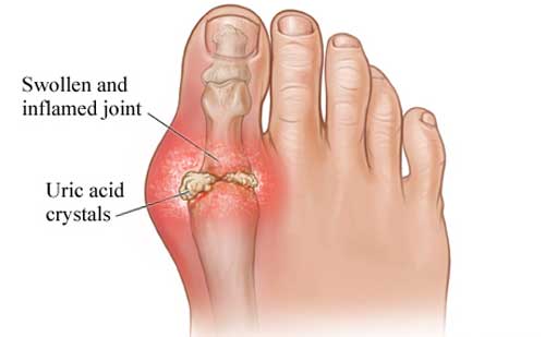 Gejala Asam Urat Dan Obatnya