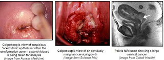 Pictures Of Cervical Cancer4