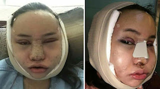  DEMI CANTIK WANITA INI RELA DI OPLAS BENGKAK KAYAK KODOK BANGKONG