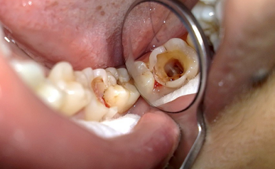 Răng khôn bị vỡ nên làm gì?