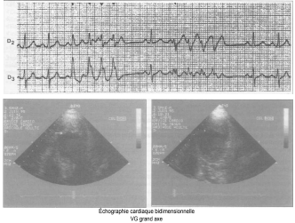 insuffisance ventriculaire gauche chez un tabagique de 55 ans