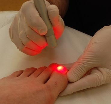 Tırnak Mantarından lazer tedavisiyle kurtulabilirsiniz