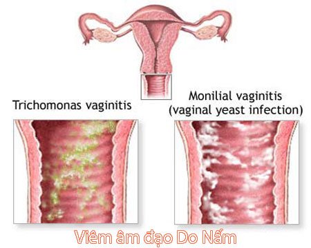 Điều trị thuốc viêm âm đạo cho giới nữ