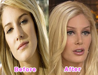 celebrity plastic surgery photos