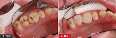Phân tích bọc răng sứ có lấy tủy không từ nha sĩ-2