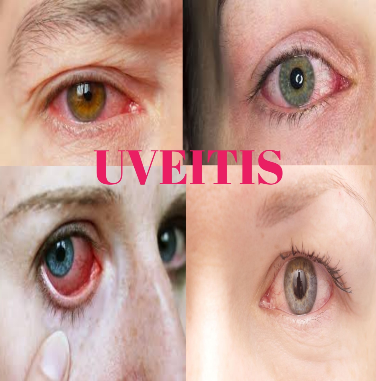 Uveitis - Know the causes and Treatment, uveitis causes and treatment