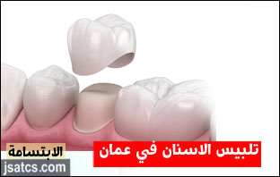 أسعار تلبيس الأسنان في سلطنة عمان