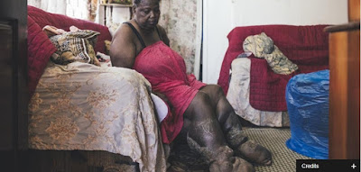 All you need to know about Lymphatic filariasis - (Elephantiasis)