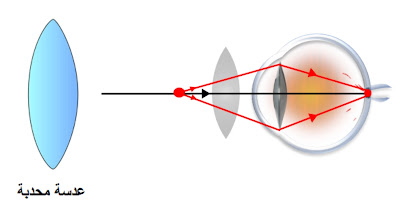 رسم توضيحي لدور "العدسة المحدبة" في تصحيح عيب "طول النظر"