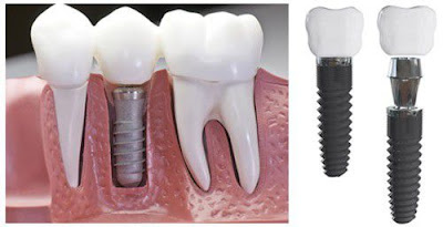  Trồng răng implant khi mất răng