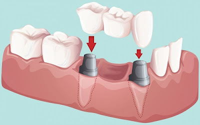 Có nên làm cầu răng sứ không? 