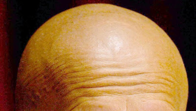 Cure for baldness coming soon, say scientists!