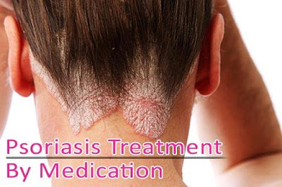 Psoriasis Treatment By Medication