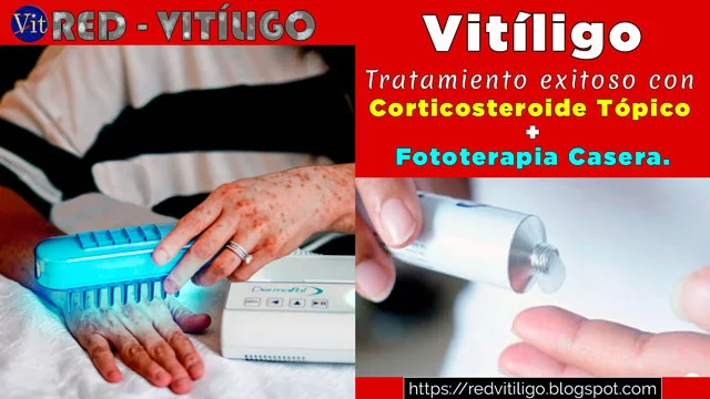 Tratamiento Para El Vitiligo -Manchas Blancas-