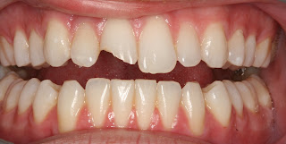 Boulder dentist patient before cosmetic dentistry.