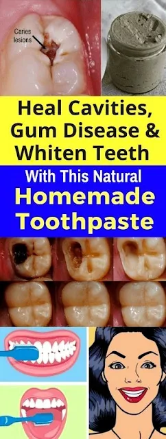 Heal Cavities, Gum Disease, And Whiten Teeth With This Natural Homemade Toothpaste