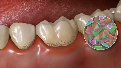 Bệnh sâu răng là gì?