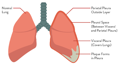 Prevention, Treatment, Screening, Staging of Mesothelioma