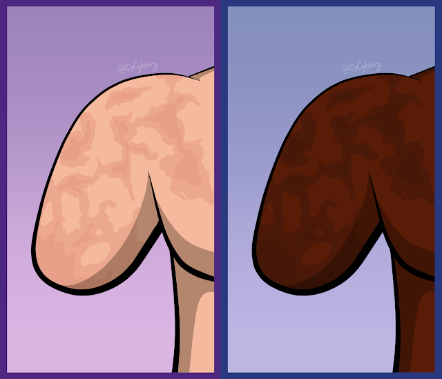 Another image of the same two stumps, side by side, this time drawn with large, burn-like scars covering the stump and part of the chest. These scars, despite being bigger than the first two images, are the same colour as the smaller scars.