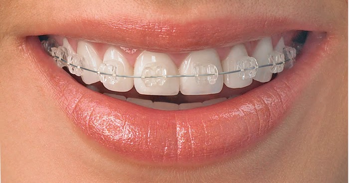 http://dentistrybangalore.com/ortho/