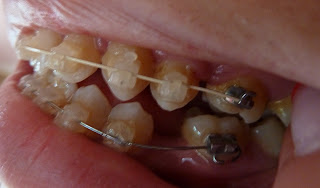 A photograph of teeth with fixed ceramic braces at week 17 of treatment