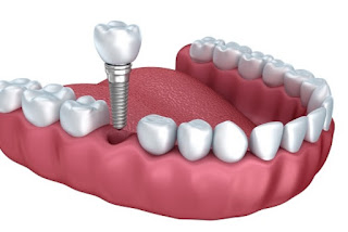 Trồng răng implant có đau không ?