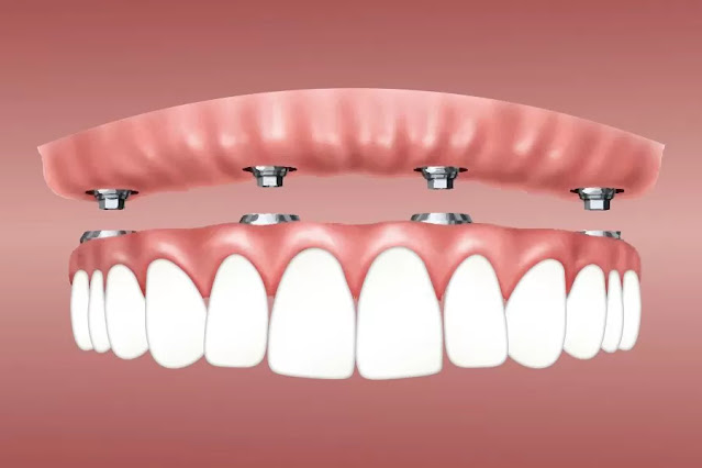 dental implants cost Melbourne