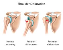  shoulder dislocation
