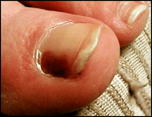 toenail-cancer-symptoms
