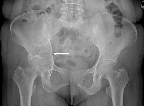 WHAT IS LIPOMA? WHAT CAUSES LIPOMA LUMPS? SYMPTOMS, WHAT IS INSIDE LIPOMA? DIAGNOSIS, BEST TREATMENT OF LIPOMA