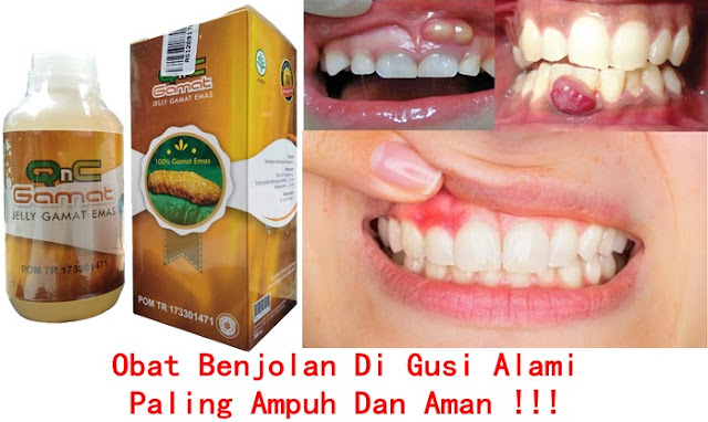 Obat Benjolan Di Gusi Alami