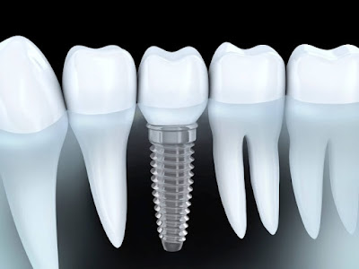 Trụ răng implant được sử dụng phổ biến