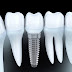 Trụ răng implant được sử dụng phổ biến