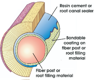 Tertiary monoblock