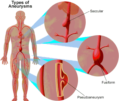 abdominal-aortic-aneurysm-definition