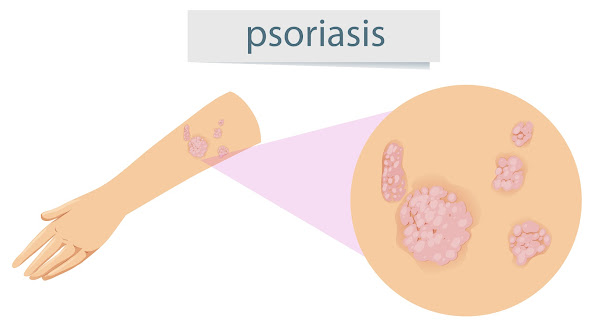 psoriasis