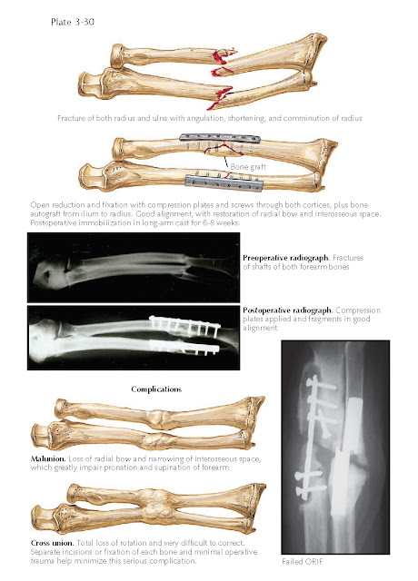 FRACTURE OF BOTH FOREARM BONES