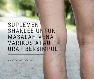 Suplemen Shaklee Untuk Masalah Vena Varikos atau Urat Bersimpul