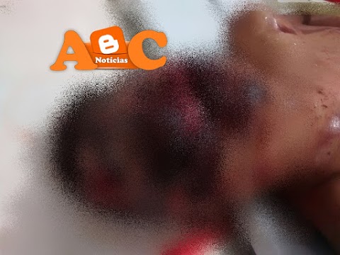 Acidente com caçamba  de Mata Roma mata jovem de 16 anos, na zona rural.