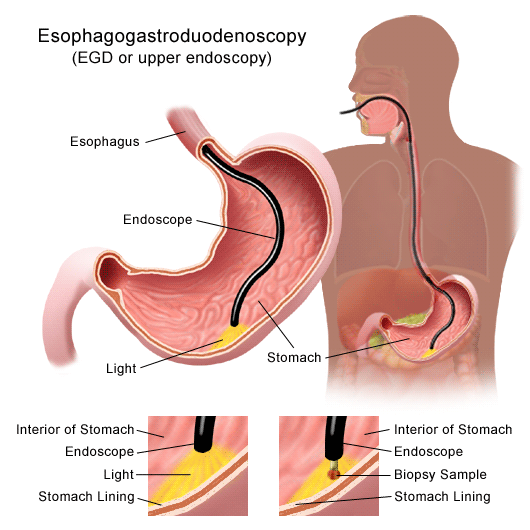 gastric ulcer is a sore in the lining of your stomach. Ulcers can be 