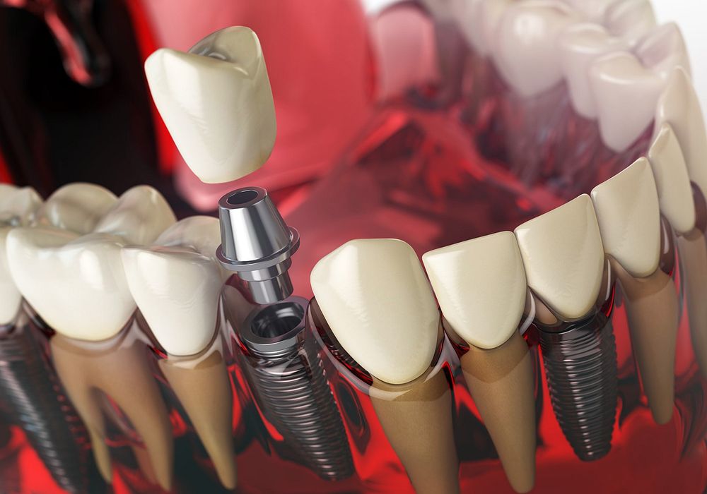 Dental Implant