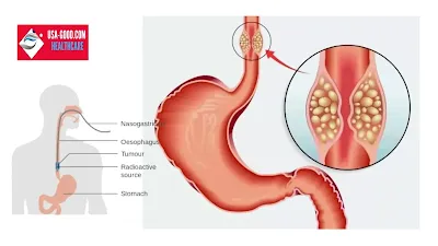 What is Esophageal Cancer?